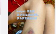 kaiyun·开云官网:阿扎尔大腿受伤，转会传言再起波澜